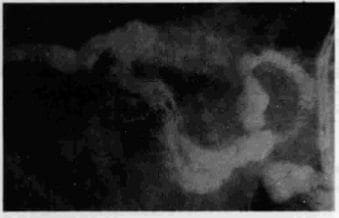 Hernia hiatal