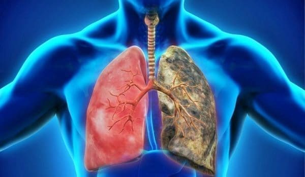 Pacientes Diagnosticados con el CIE-10 para Enfermedad Pulmonar Obstructiva Crónica