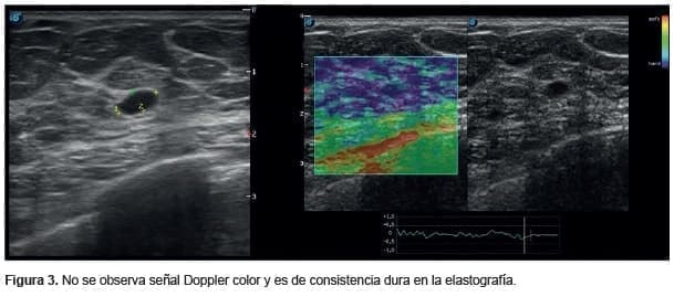 Carcinoma de células claras renales, Elastografía