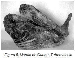Momia de Guane: Tuberculosis
