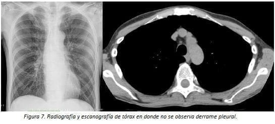 Derrame Pleural Radiografía y Escanografía de Tórax