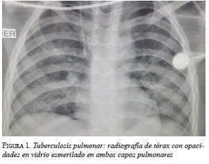 Tuberculosis Pulmonar