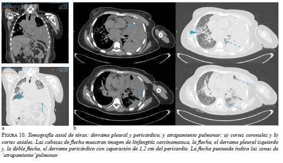 Derrame Pleural y Pericárdico