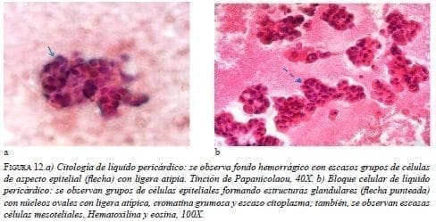 Citología de Líquido Pericárdico