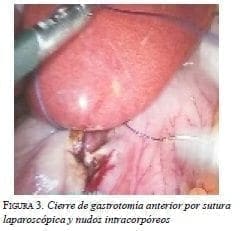 Cierre de Gastrotomía
