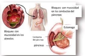 Qué es la Fibrosis Quística