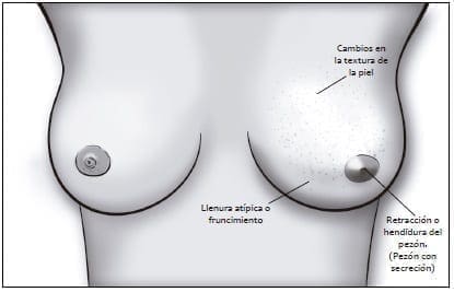 Autoexamen de seno