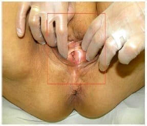 Atrofia vulvogenital
