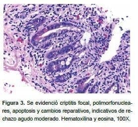 Criptitis focal