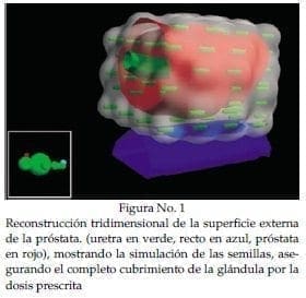 Superficie externa de la próstata