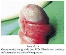 Compromiso del glande por BXO