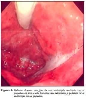 Endoscopio con el protector
