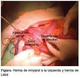 Hernia de Amyand a la izquierda y hernia de Littré