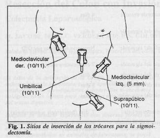 Trócares para la sigmoidectomía