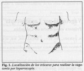 Localización de los trócares para realizar la vagotomía por laparoscopia