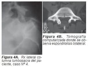 Espondilolisis bilateral