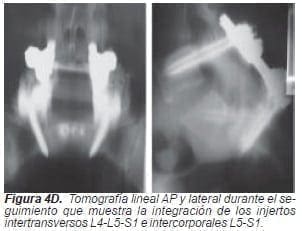Injertos intertransversos L4-L5-S1