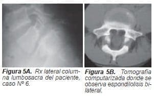 Espondilolisis bilateral