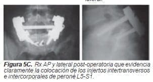 Injertos intertransversos e intercorporales de peroné