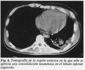 Drenaje Quirúrgico Cervicotorácico, lóbulo inferior izquierdo