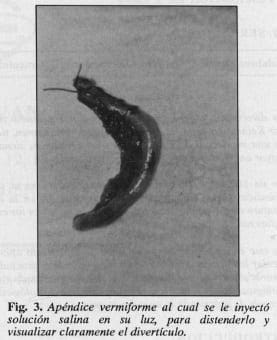 Apéndice vermiforme, visualizar del divertículo - Diverticulosis y Diverticulitis Apendicular Apéndice vermiforme, visualizar del divertículo - Diverticulosis y Diverticulitis Apendicular