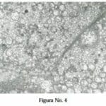 Carcinoma Renal de Células Cromófobas