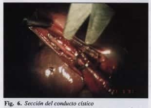 Sección del conducto cístico