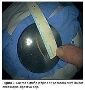 Perforación de Colon, endoscopia digestiva baja