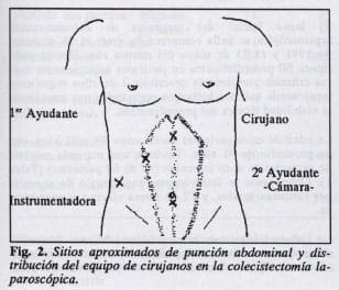 Sitios de punción abdominal