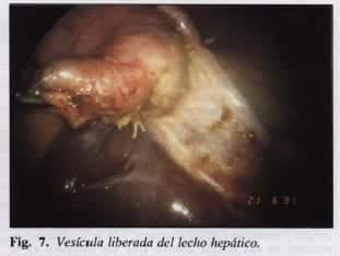 Vesícula liberada del lecho hepático