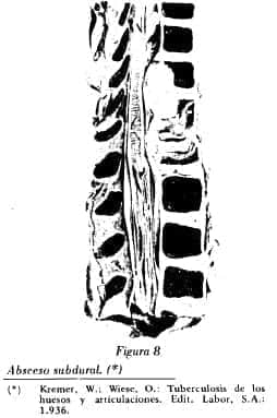 Absceso subdural Absceso subdural