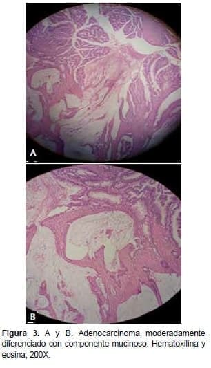 Adenocarcinoma con Componente Mucinoso