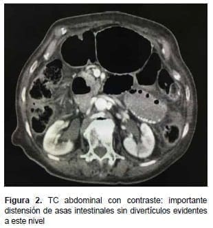 Distensión de Asas Intestinales sin Divertículos