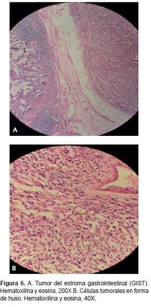 Tumor del Estroma Gastrointestinal