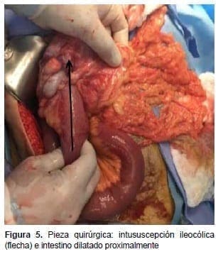 Intususcepción Ileocólica e Intestino Dilatado