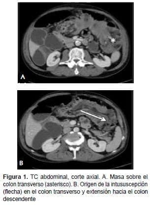 Masa sobre el Colon Transverso