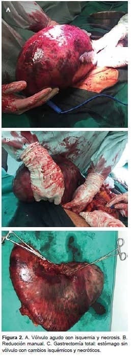 Vólvulo Agudo con Isquemia y Necrosis