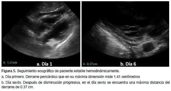 Ecografía de Derrame Pericárdico 
