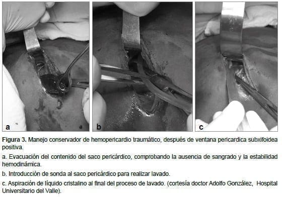 Hemopericardio Traumático después Pericardica Subxifoidea positiva