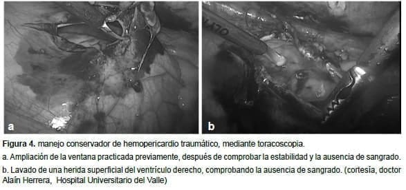 Hemopericardio Traumático por Toracoscopia