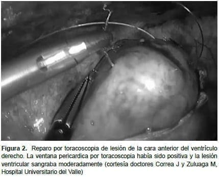  Toracoscopia de Lesión del Ventrículo derecho