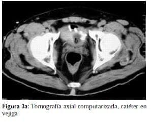 Tomografía axial computarizada, Catéter en Vejiga Tomografía axial computarizada, Catéter en Vejiga