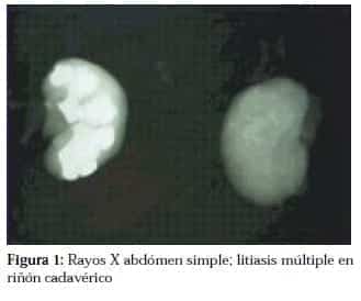 Litiasis Múltiple en Riñón Cadavérico