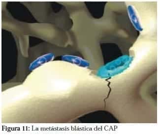 Metástasis Blástica del CAP