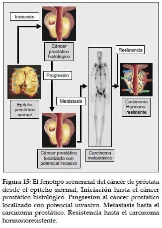 Fenotipo secuencial del Cáncer de Próstata