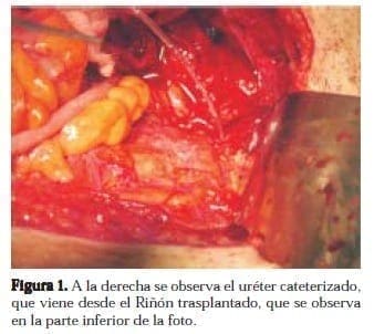 Uréter Cateterizado