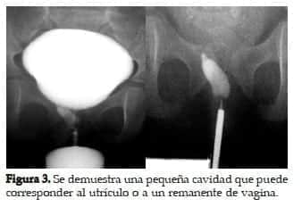 Utrículo Prostático o a la Vagina