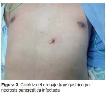 Cicatriz del Drenaje Transgástrico por Necrosis Pancreática Infectada