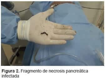 Fragmento de Necrosis Pancreática Infectada
