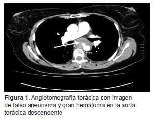 Gran Hematoma en la Aorta Torácica Descendente